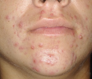 causes acné chez l’adulte